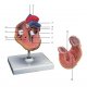 Model ľudského srdca s hypertrofiou ľavej komory - 2 časti
