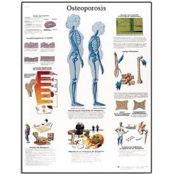 Schéma - osteoporóza - AJ - 50x67 cm