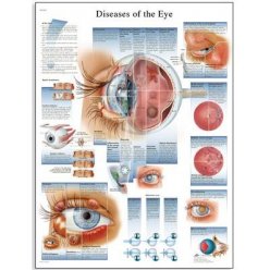 Schéma - choroby ľudského oka - AJ - 50x67 cm