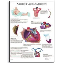 Schéma - bežné ochorenie srdca - AJ - 50x67 cm